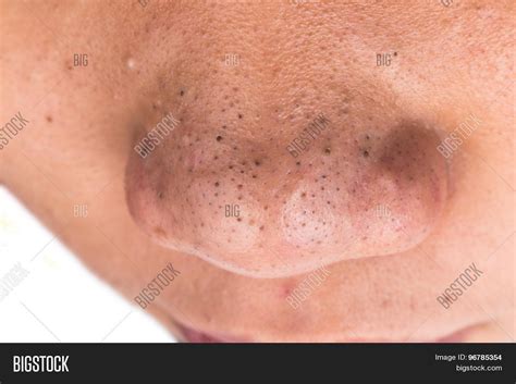 Close On Pimple Image And Photo Free Trial Bigstock