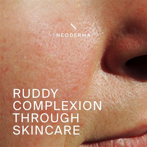 Ruddy Complexion Through Skincare Neoderma