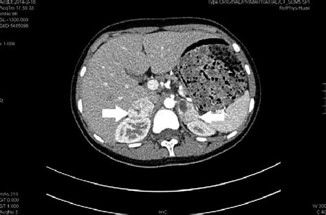 Enhanced Ct Of Bilateral Adrenal Glands Showing 2 Round Like Masses