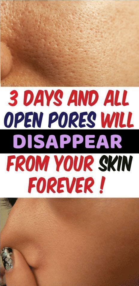 Days And All Open Pores Will Disappear From Your Skin Permanently Pore Enlarged Pores