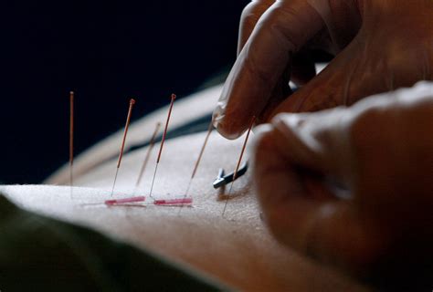 Stanford University Acupuncture Reduces Pain After Surgery Ancient