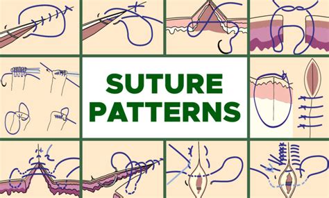 Common Suture Patterns And Suture Techniques Endogynecology