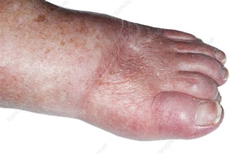 Foot Oedema Stock Image C0234303 Science Photo Library