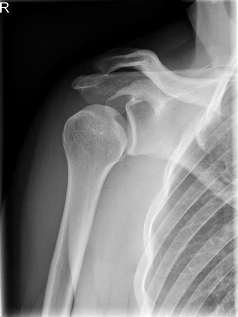 Posterior Shoulder Dislocation And Reverse Hill Sachs Radiology Case