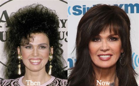 Marie Osmond Plastic Surgery Before And After Latest Plastic Surgery