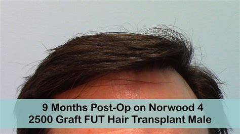 Fut Hair Transplant Video Gallery Sure Hair International Hair Restoration Toronto