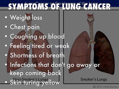 Lung Cancer By Kaylee Krzoska