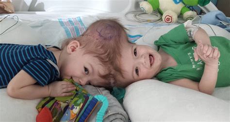 Conjoined Twins Open Their Eyes For The First Time After Separation