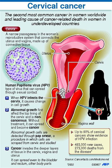 Cervical cancer incidence and mortality cervical cancer second most common cancer in malaysia, furthermore, it is the fourth most common cause of death in women in malaysia. Vinegar test helpful vs cervical cancer | Inquirer Lifestyle