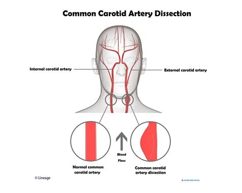 Carotid Dissection Cardiovascular Medbullets Step 2 3