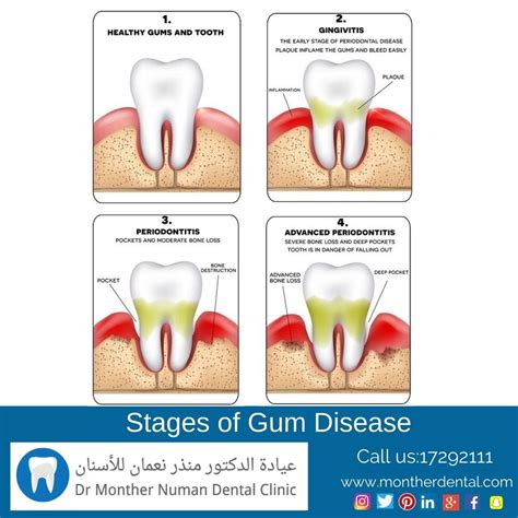 Gum Disease Is A Doctor Monther Numan Dental Clinic