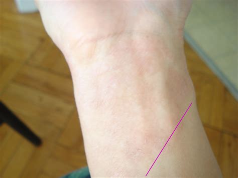 Eczema Rash On Wrist