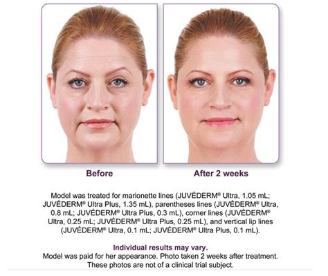 JuvÉderm® Xc Injectable Gel Is For Injection Into Areas Of Facial