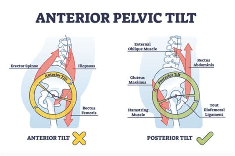 Anterior Vs Posterior Pelvic Tilt Difference Causes And Symptoms