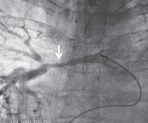 Arteriografía Pulmonar Arteria Pulmonar Derecha Flecha Con Un