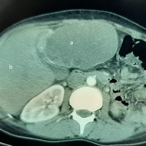 Abdominal Ct Scan Showing A Hydatid Cyst Of The Left Lobe Of The Liver
