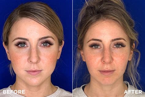 How much does a nose job cost? Two procedures for slimming down a round face - Madnani Facial Plastics