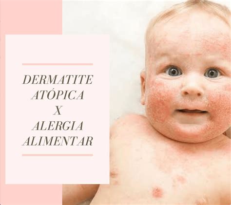 Dermatite At Pica X Alergia Alimentar Guia Sa De Cidades