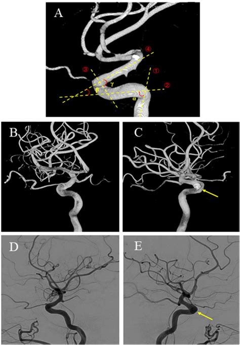Angle Measurement In A Patient With Unilateral Carotid Siphon