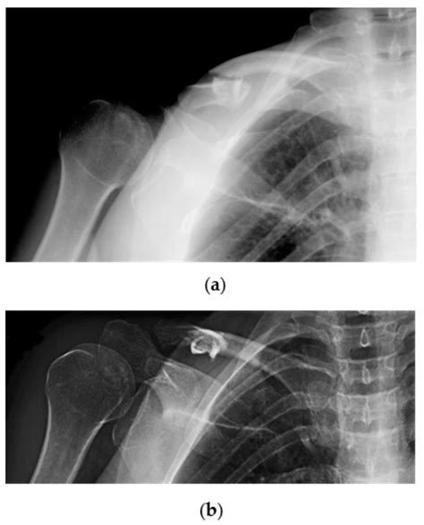 Jpm Free Full Text Management Of Displaced Midshaft Clavicle
