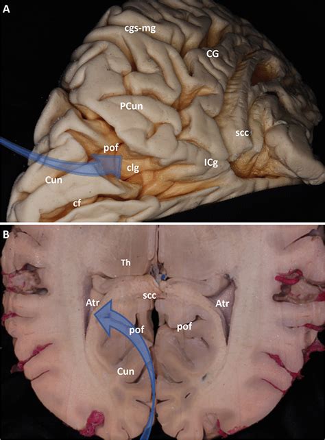 The Trajectory Of The Parieto Occipital Fissure Approach A A Silicone