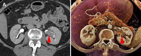 A Axial Contrast Enhanced Excretoryurographic Phase 2d Ct Image From