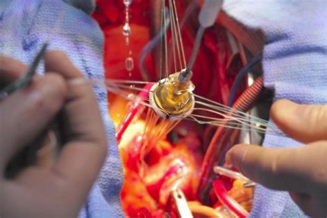 Dwupłatkowa zastawka aorty czym jest przyczyny wady rokowania