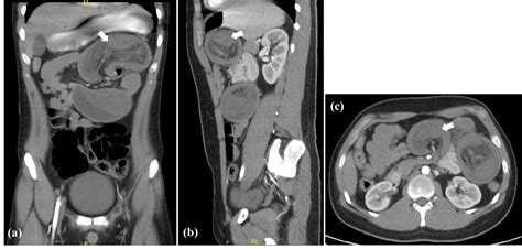Cureus Atypical Peutz Jeghers Syndrome Presenting With A Huge Jejunojejunal Intussusception In
