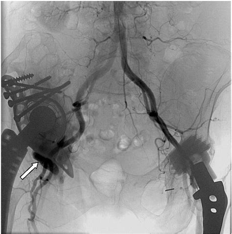 Aneurysm Of The Femoral Artery Caused By Aseptic Loosening And