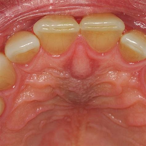 − Intraoral Examination Showing Swelling In The Hard Palate With A