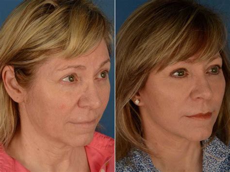 The Uplift™ Lower Face And Neck Lift Photos Naples Fl Patient 13540