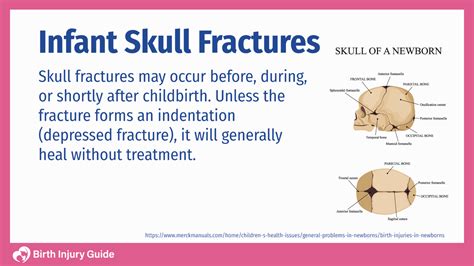 Infant Skull Fractures Birth Injury Guide