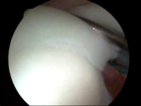 Shoulder Arthroscopic Acromioplasty Youtube