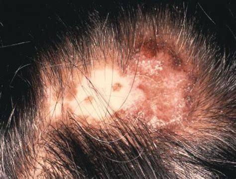 What Is Lupus Of The Scalp Thwais