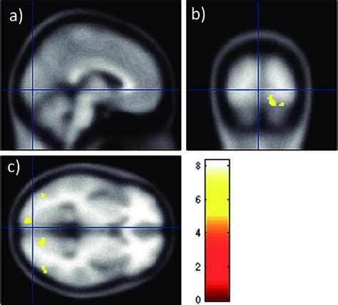 Functional Magnetic Resonance Imaging Fmri Following The Visual