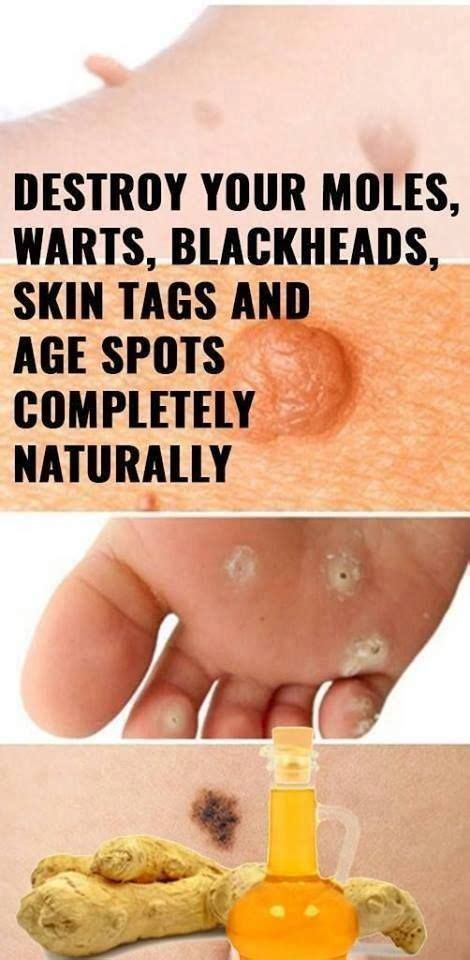 How To Remove Moles Warts Blackheads Skin Tags And Dark Spots Mole