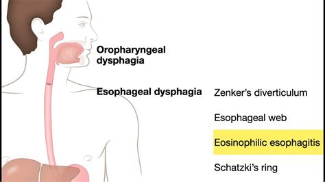 Ece Lesson 2f4 Pathology Of Esophagus Eosinophilic Esophagitis Youtube