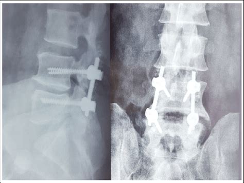 Plain X Ray Thoracolumbar Spine Showing Post Operative Images Of A L4 5