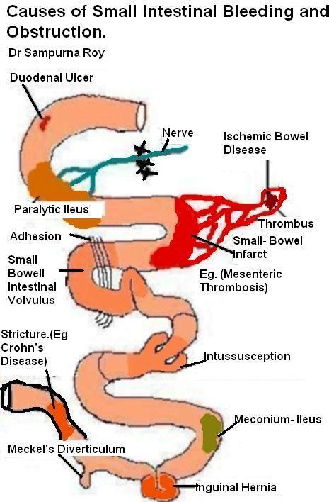 Bowel Obstruction Overview Of Causes Clinical Feature