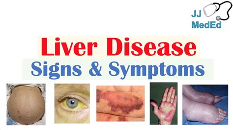 Signs And Symptoms Of Liver Disease Emu Articles