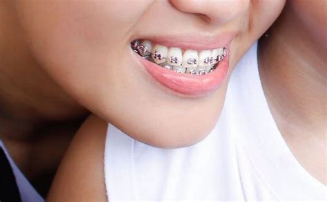 Colorful Teeth Braces Ideas Be Irresistible And Make A Fashion Statement
