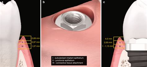 Biologic width around dental implants: Peri-implant Plastic Surgery | Pocket Dentistry