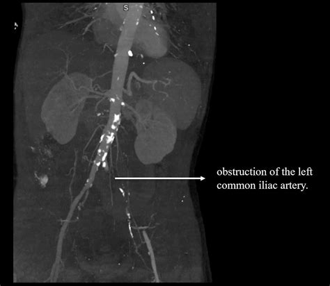 Cureus Systemic Embolization As The Initial Presentation Of A Rare