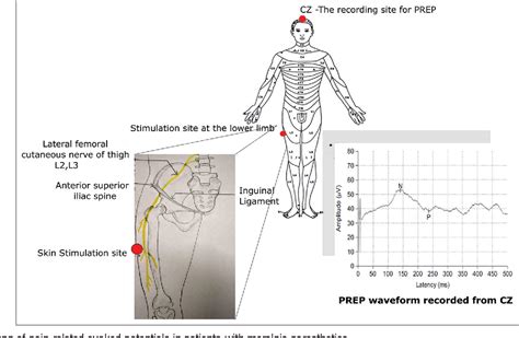 Figure 1 From Role Of Pain Related Evoked Potential In The Diagnosis Of