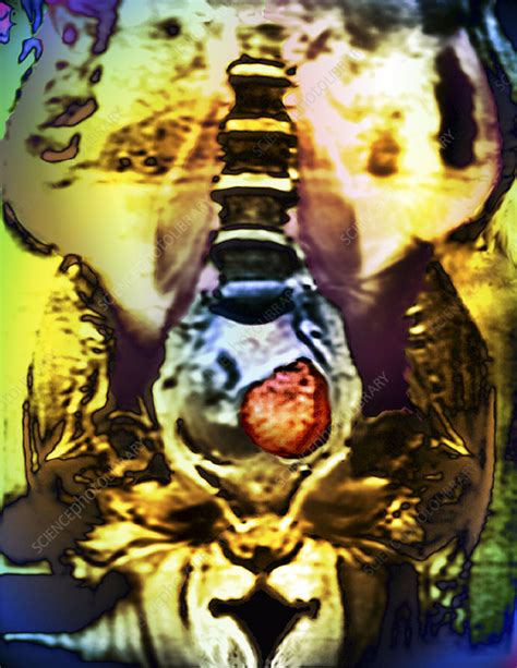 Ovarian Cancer Ct Scan Stock Image M8500627 Science Photo Library