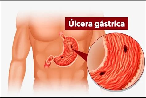 Úlcera gástrica causas sintomas e tratar com misoprostol