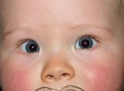The skin folds at the inner corner of the eyelids are called epicanthal folds and can be broad in some babies. Pseudostrabismus - American Association for Pediatric ...