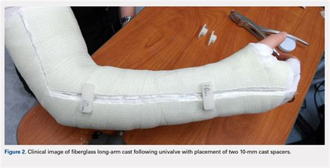 Volumetric Considerations For Valving Long Arm Casts The Utility Of
