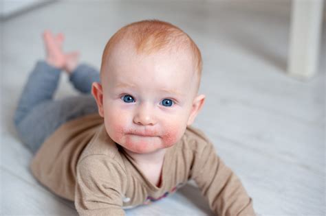 Atopowe zapalenie skóry AZS u niemowląt i małych dzieci