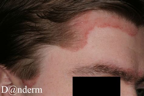5 18 4 Psoriasis Of Hairline And Eyebrow Also In Large Size